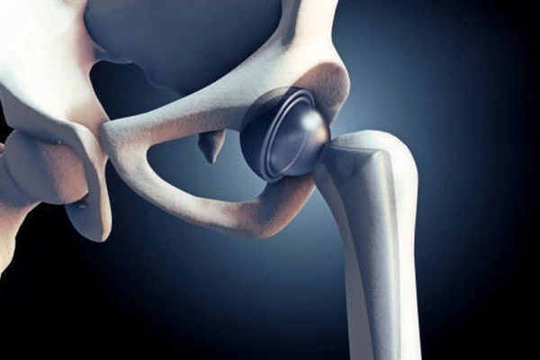 Hip and knee joint replacements