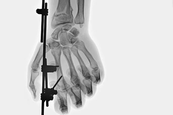 Bone screws and trauma fixation devices