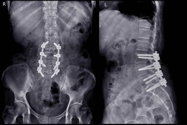 Spinal implants
