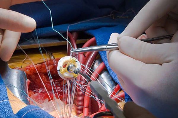 Cardiovascular and neurological implant systems